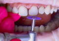 tooth being polished by purple disc