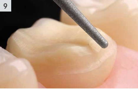 8856 diamond bur finishing the interproximal region of a tooth