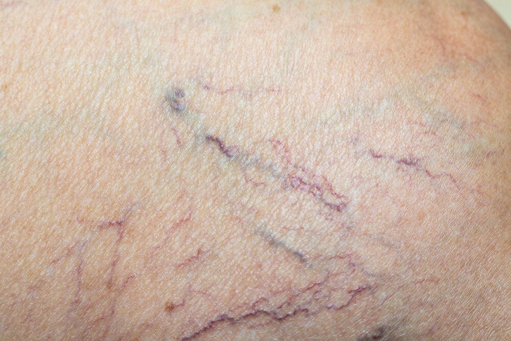 vascular lesions and broken capillaries