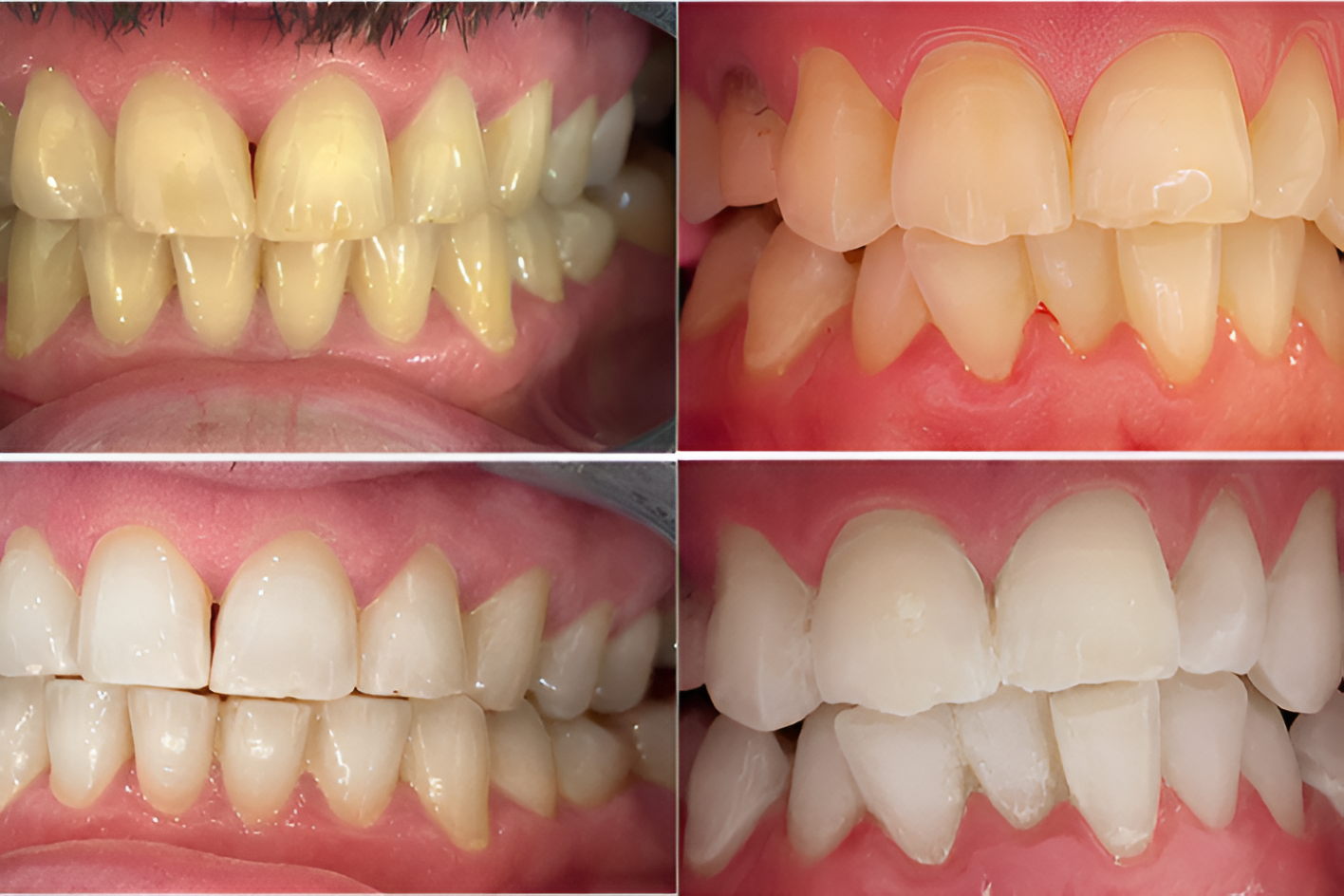 Customised Cosmetic Teeth Whitening $10 Voucher - Image 6