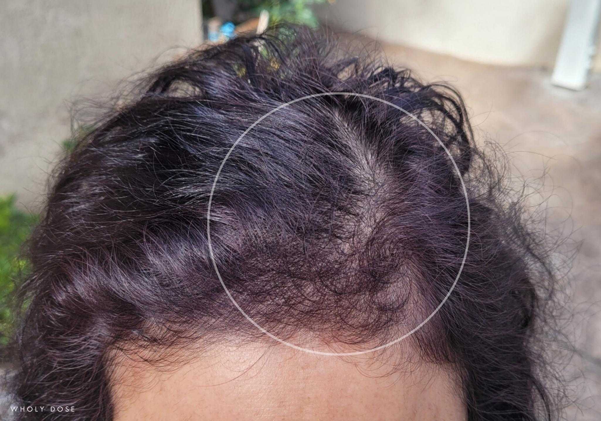 marine-collagen-biotin-hyaluronic-acid-supplement-before-after-hair-growth-results-1