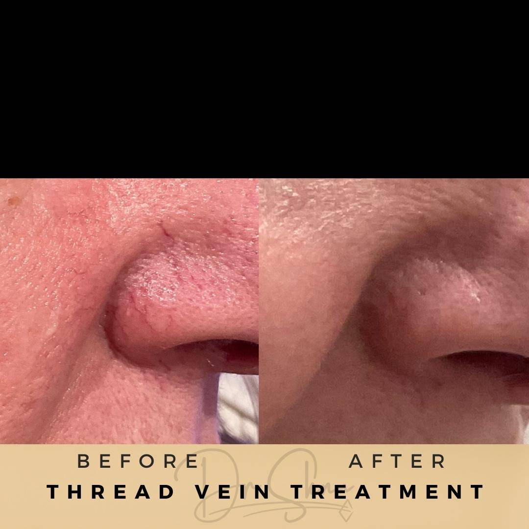 Vascular Treatment Thread Vein Treatment Wilmslow Before & After Dr Sknn