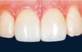 upper teeth after restoration in black background