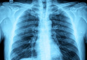 14 Ways to Help Your COPD Symptoms