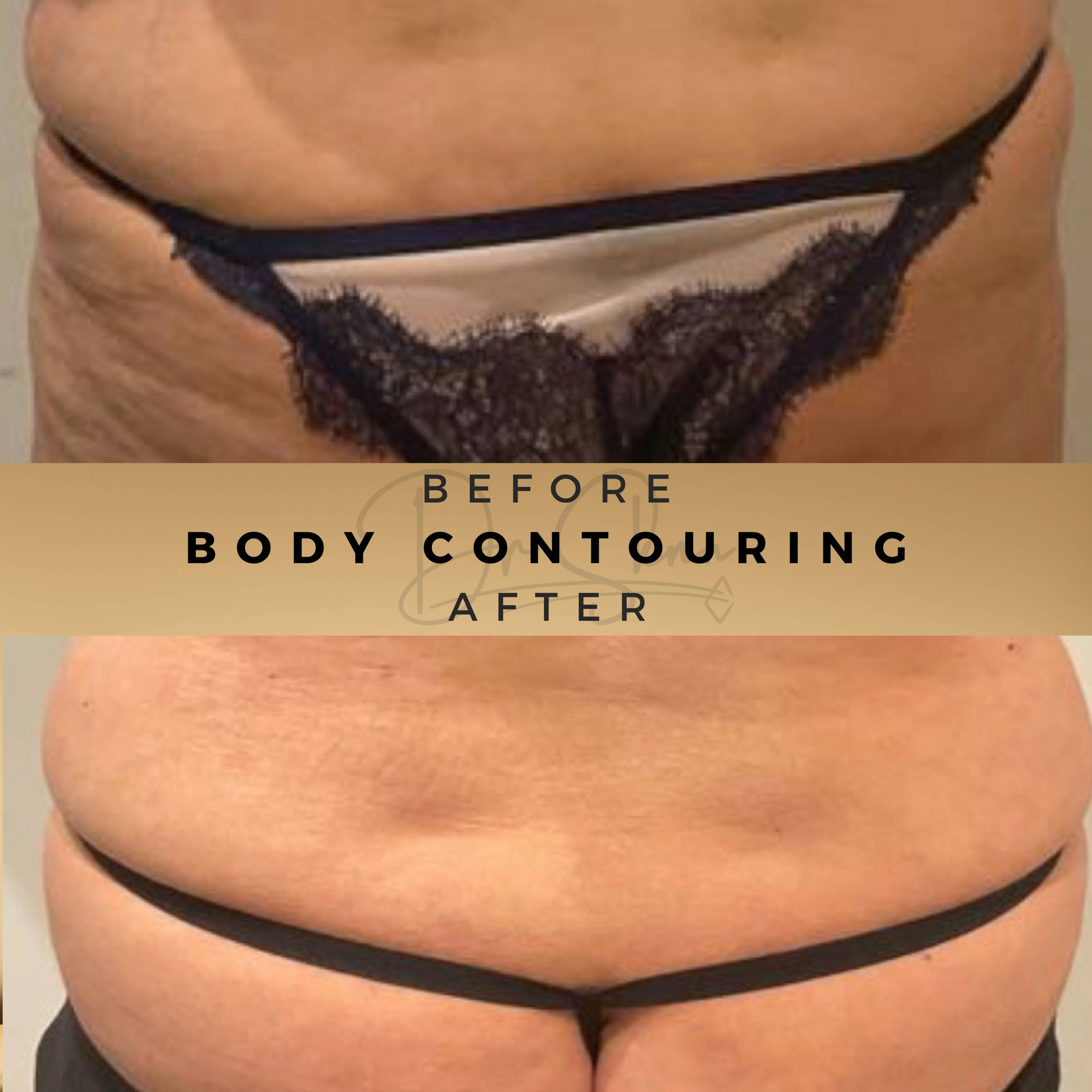 Body Contouring Wilmslow