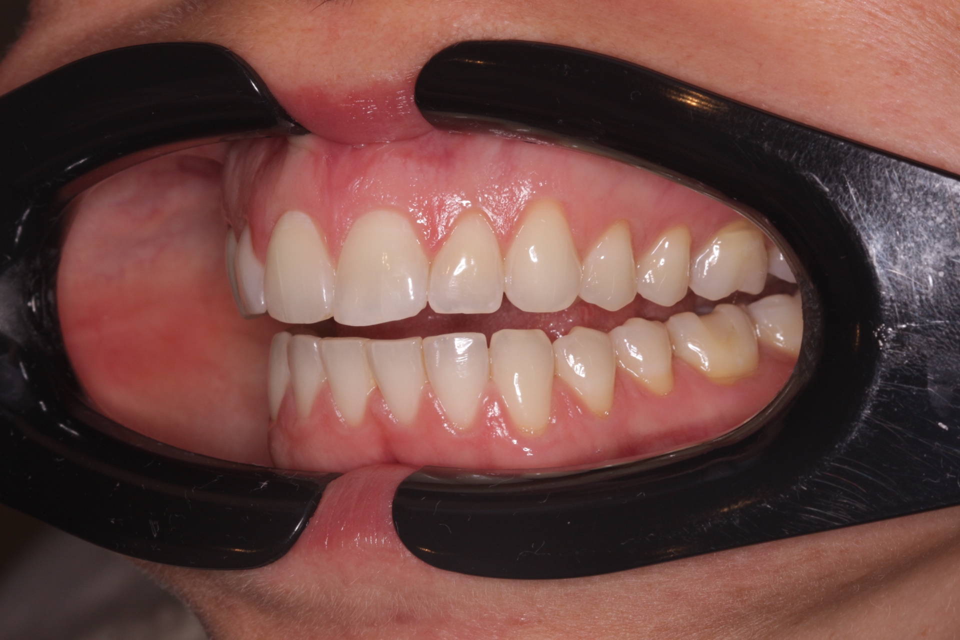 patient with lip retractor revealing teeth and gums