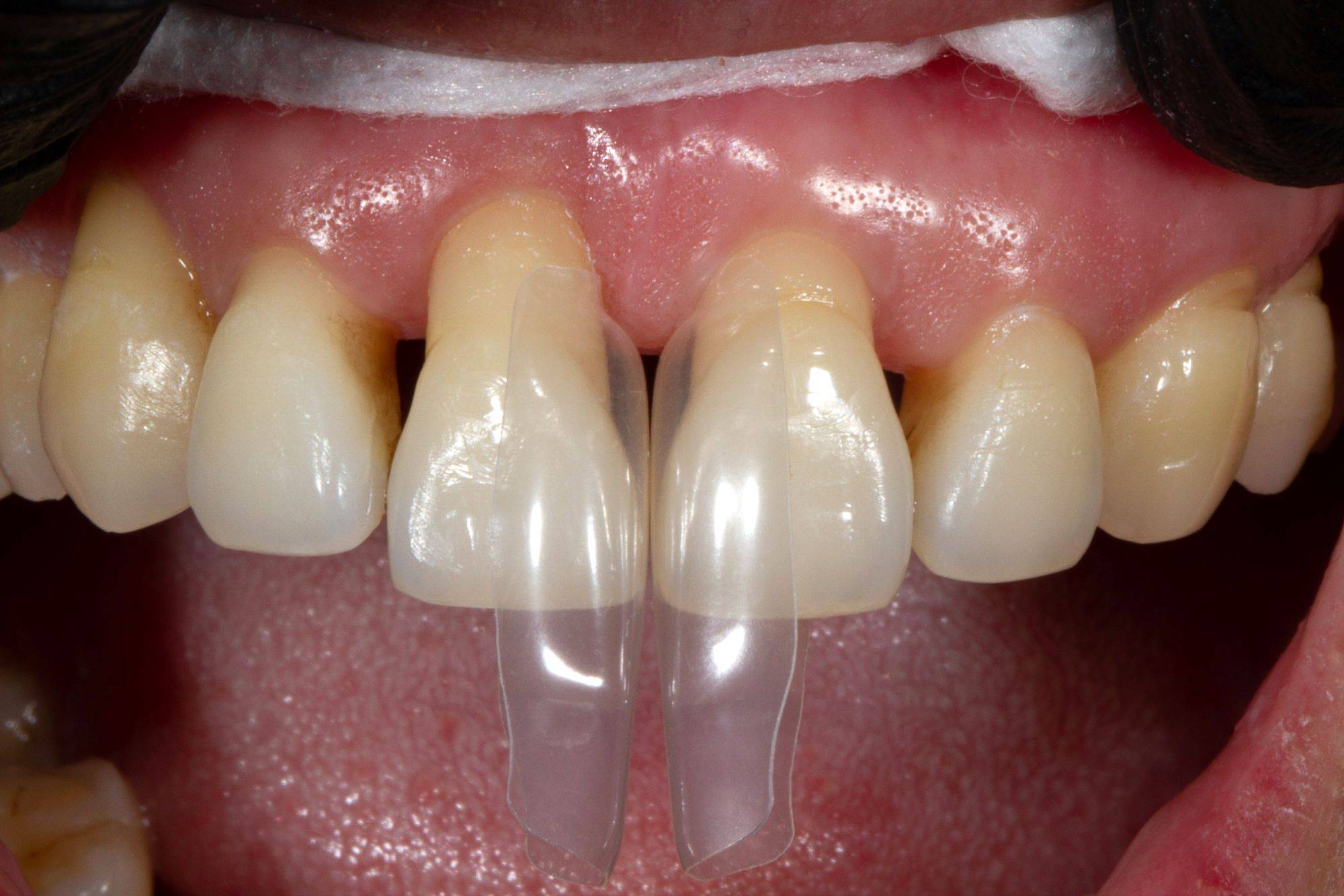 Matrix placed in central upper incisors