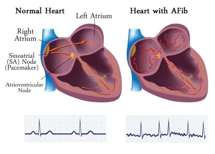 what is AFib