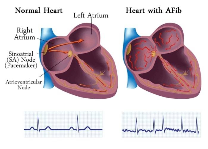 ما هو AFib