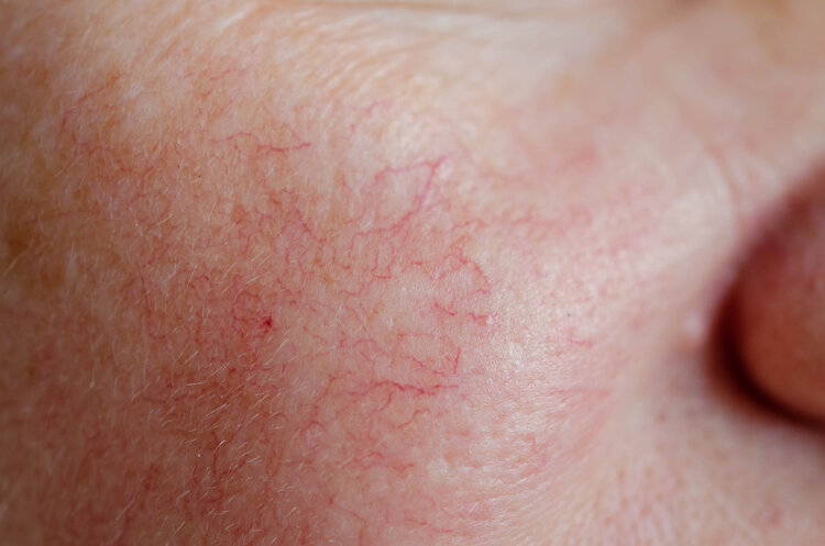 redness and rosacea