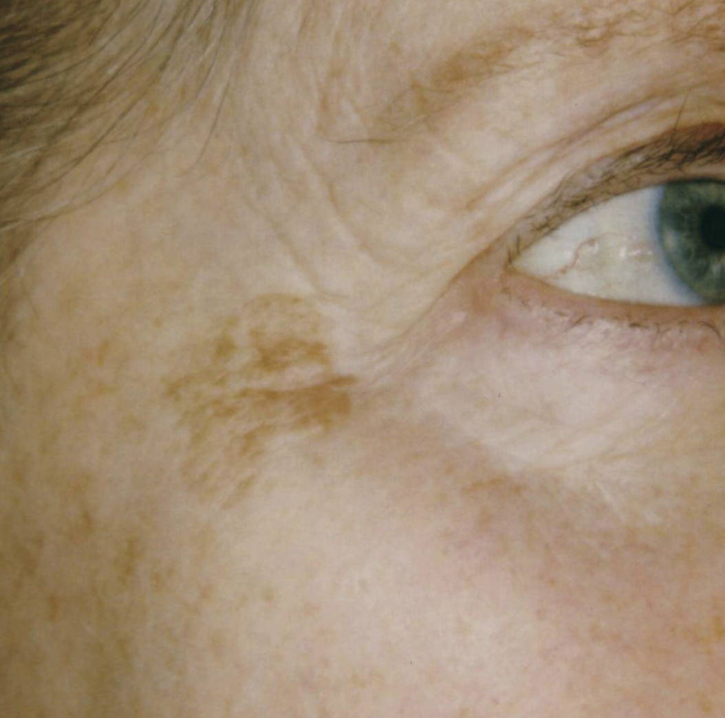 Intense Pulsed Light Pigmentation Removal Before