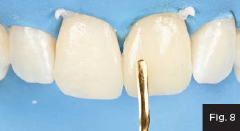 the second increment was thinned across the facial enamel with an REJ #04 composite instrument