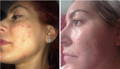 Acne Before and After Results With Vegan Collagen