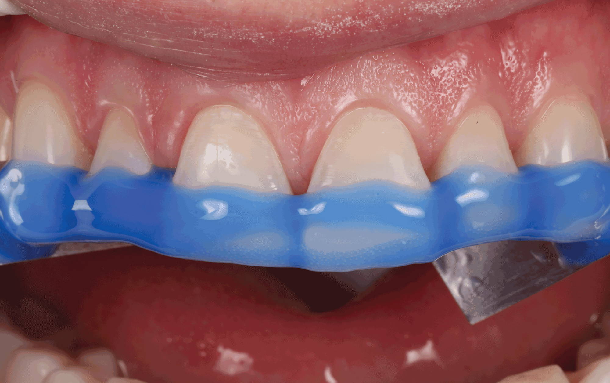 upper anterior teeth half covered in blue goo