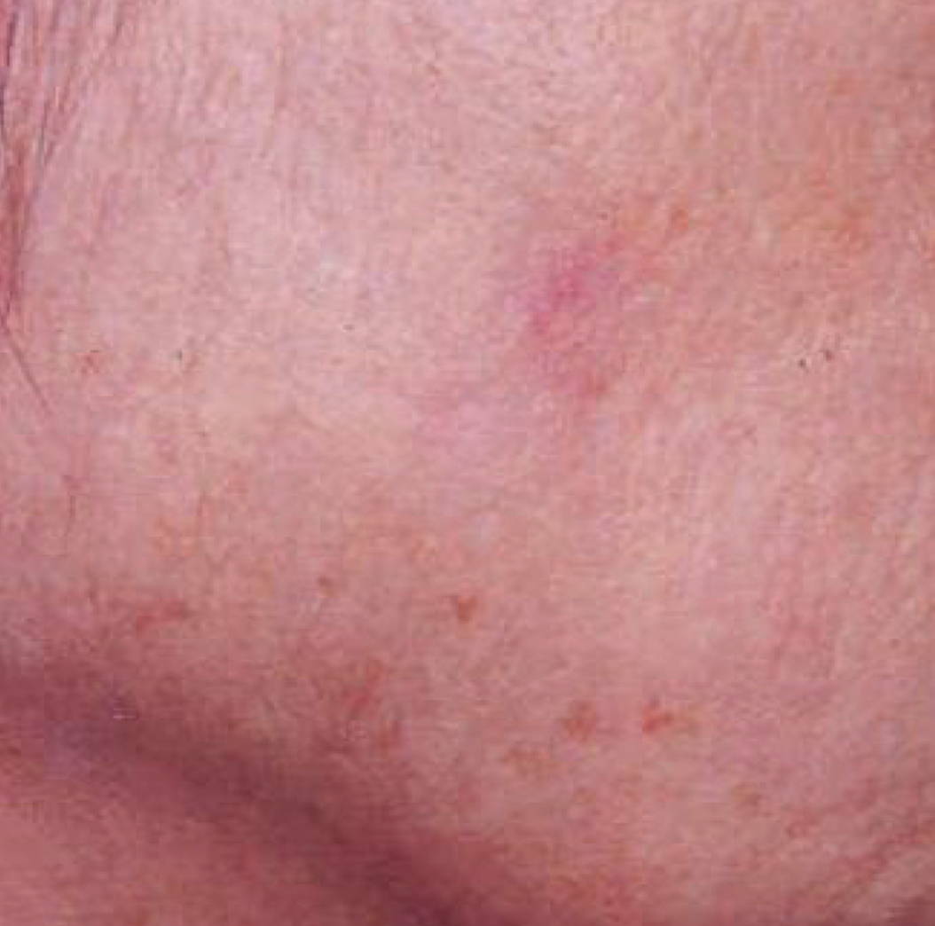 Intense Pulsed Light Pigmentation Removal After