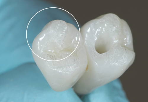 two teeth looking zirconia with a white circle highlighting a detail