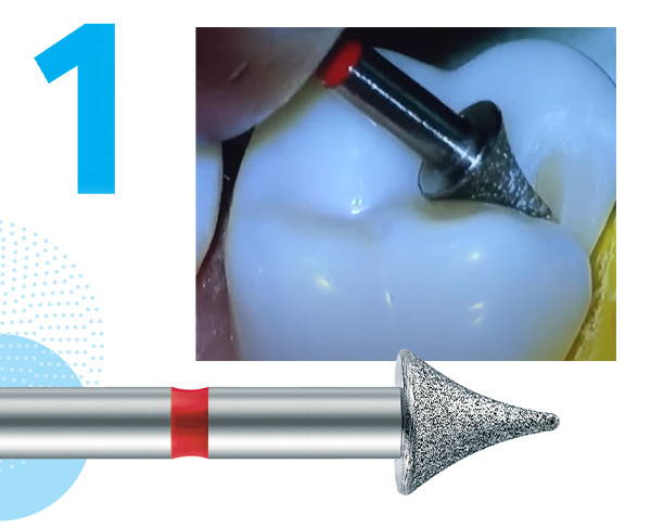 Bestseller #1: Komet 8833 Diamond Trimming bur and a clinical example of a bevelled preparation