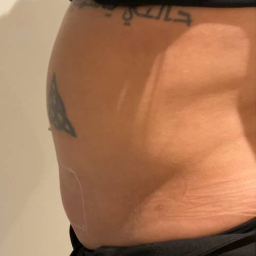 Dr Sknn Fat Reduction Belly Before