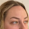 TEAR TROUGH FILLER AFTER