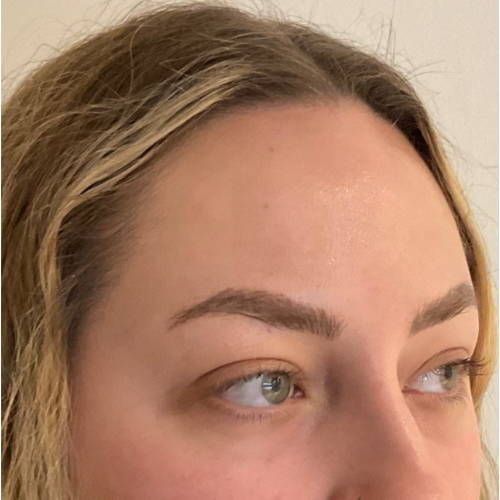TEAR TROUGH FILLER AFTER