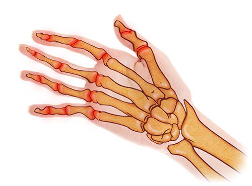 RHEUMATOID ARTHRITIS ILLUSTRATION