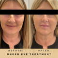 Before & After Pictures Dr Sknn Wilmslow Cheshire