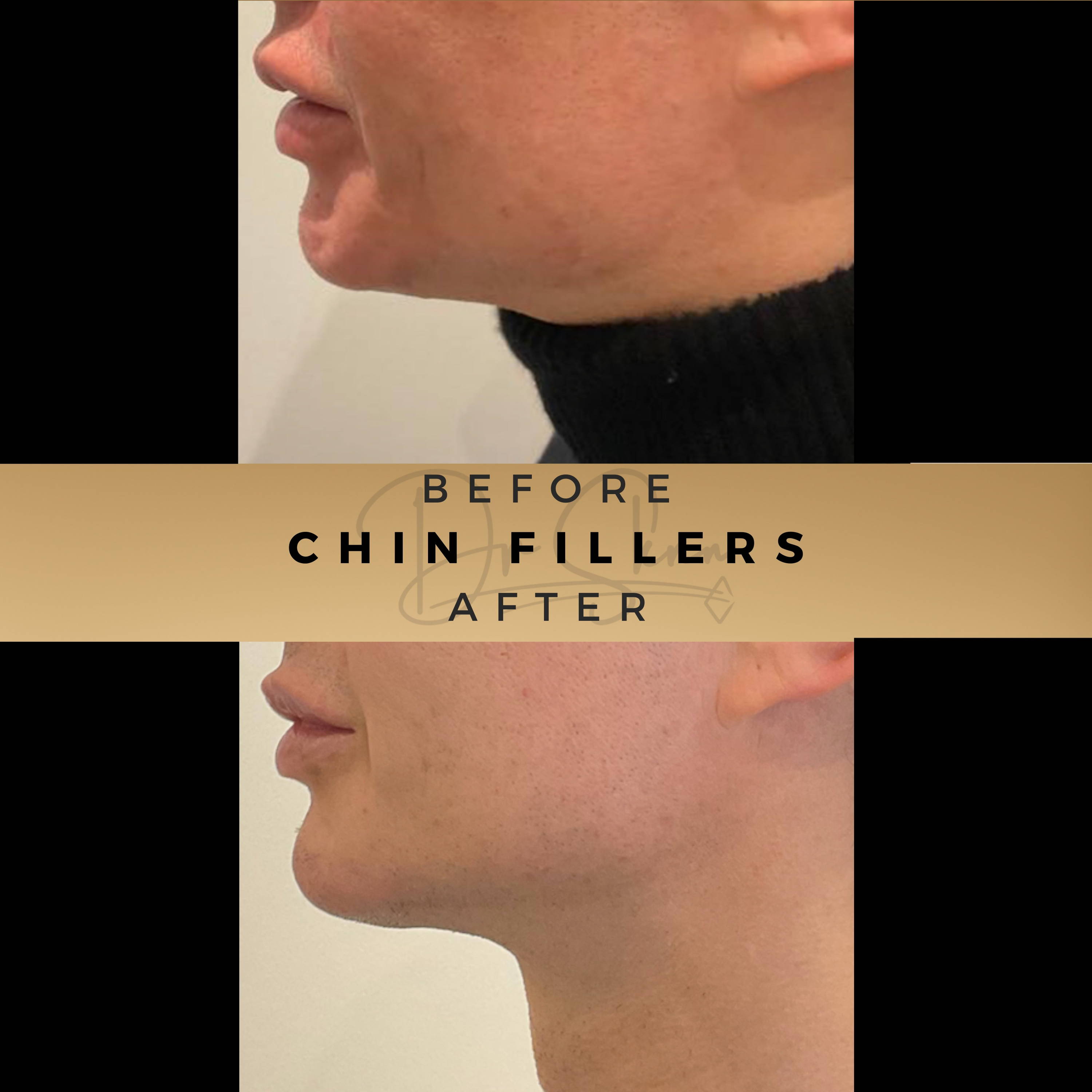 Chin Fillers Wilmslow Before & After Dr Sknn