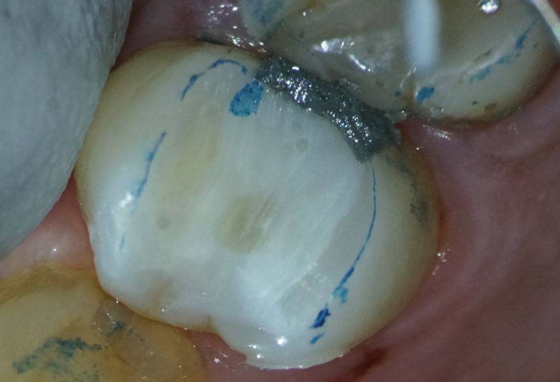 Tooth core incrementally built-up and cured.