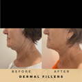 Jawline fillers Dr Sknn Before & After Picture