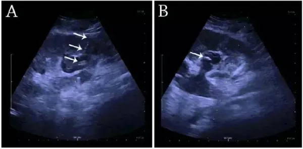 Percutaneous nephrostomy with a fistula image scanned by EagleView portable ultrasound