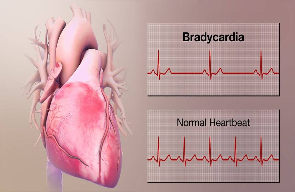 bradycardia, low heart rate