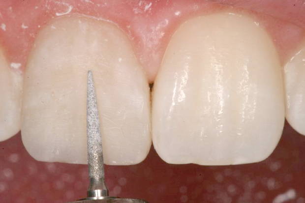 carbide bur touching tooth