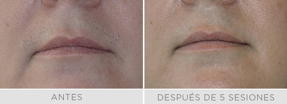 Antes y después de 5 sesiones de depilación láser en bozo