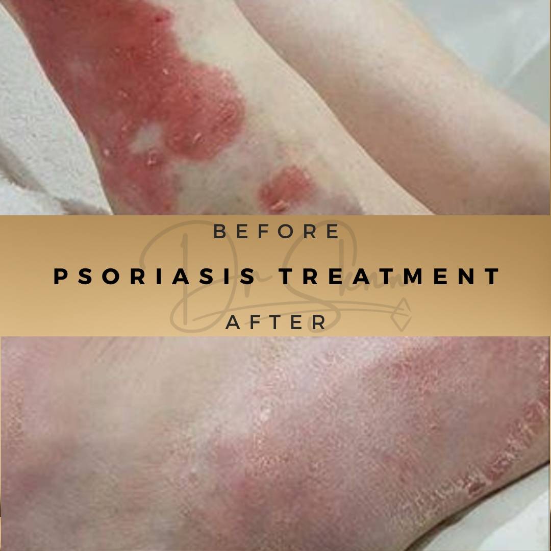 Psoriasis Treatment Wilmslow Before & After Dr Sknn