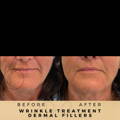 Perioral Line Fillers Wilmslow Before & After