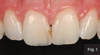 diastema closure that does not reflect the translucency of the restored tooth