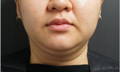 Double-chin before