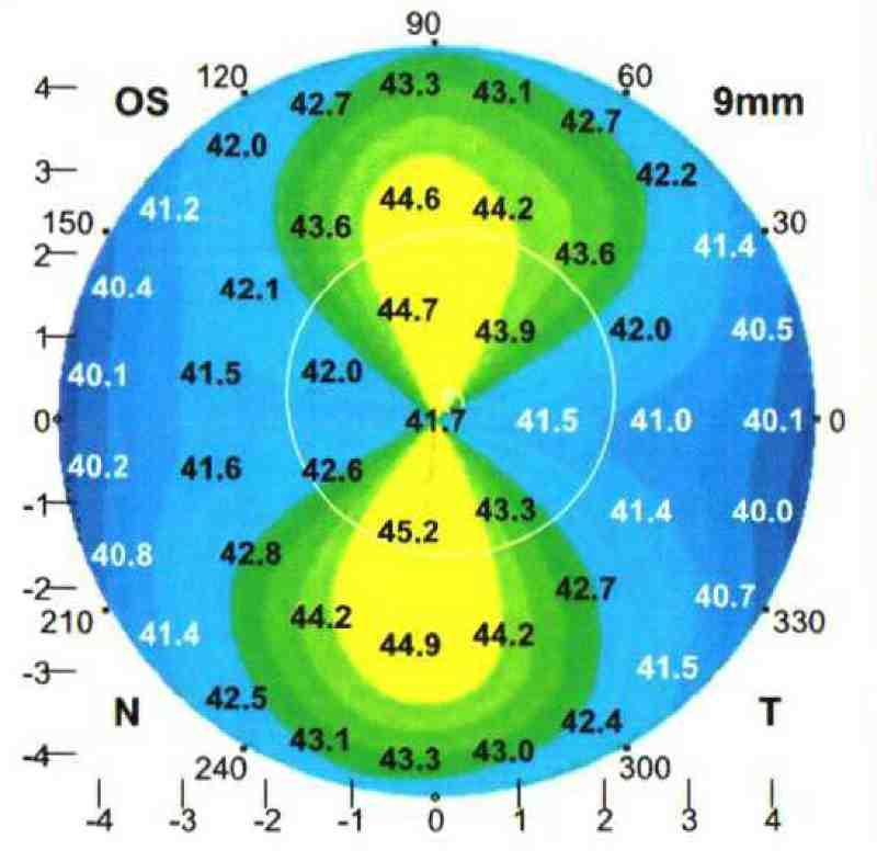 Corneal topography map of "with the rule" astigmatism