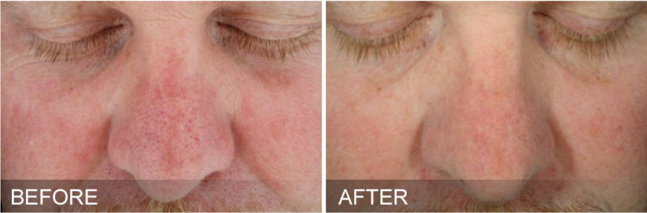 Dr Sknn Hydrafacial Before & After Picture