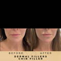 Chin Fillers Wilmslow Before & After Dr Sknn
