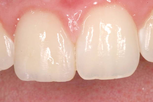 Final result of esthetic polished tooth
