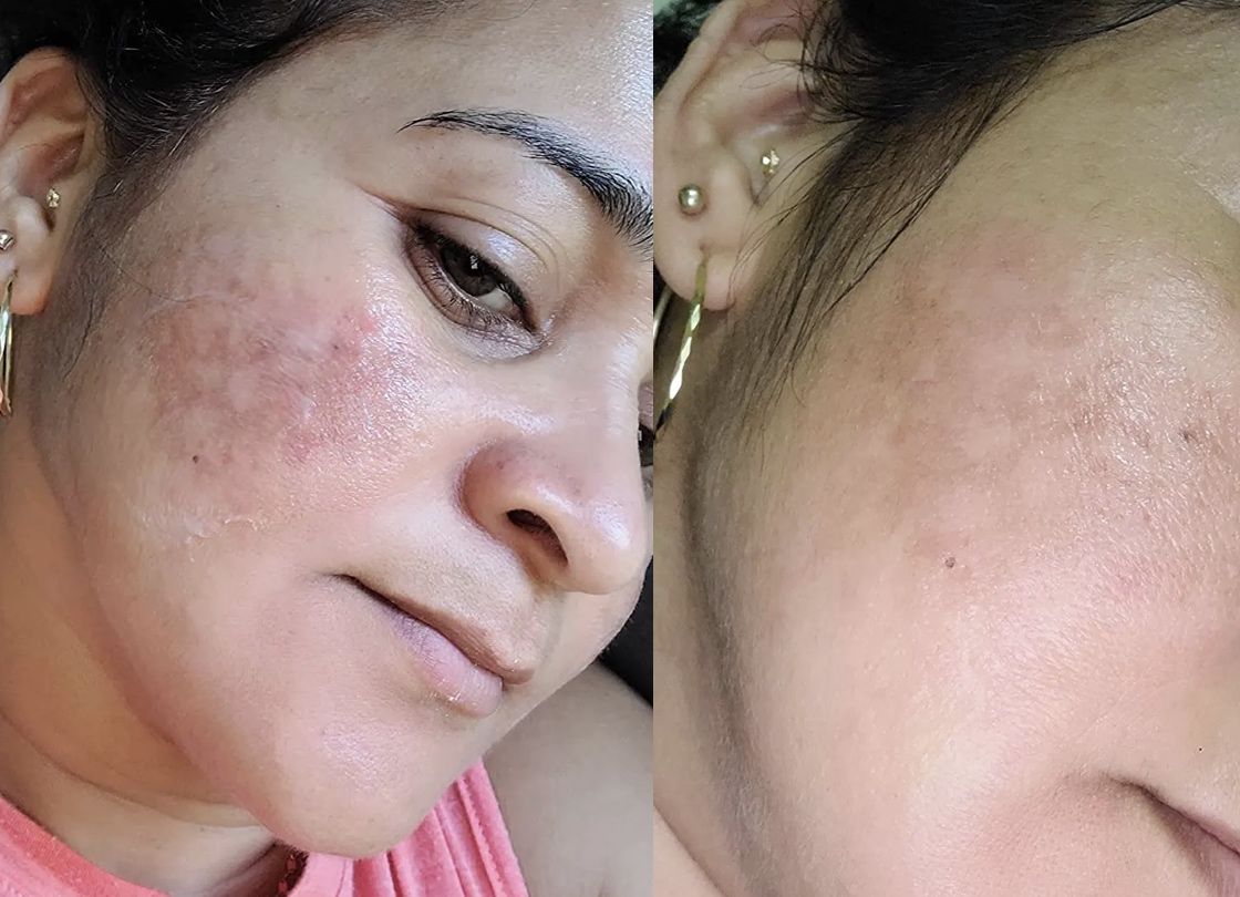 Jennifer L. before and after