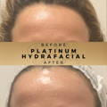HydraFacial Wilmslow Dr Sknn Before & After Picture