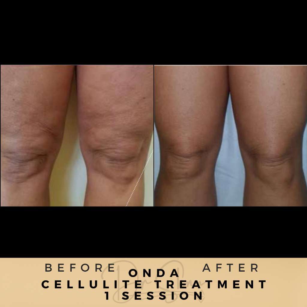 Cellulite Treatment Wilmslow Before & After Pictures Dr Sknn - Onda treatment