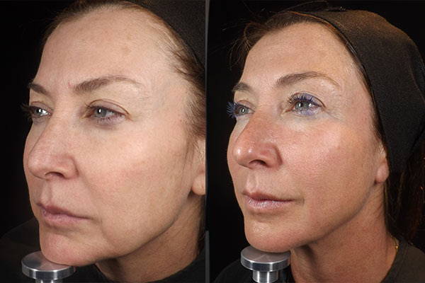 PDO Thread Lifts, Before & After Treatment, Medicetics London