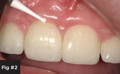 The patient refused anesthesia and we proceeded to use a #4 CeraBur at 10,000 RPMs around the margin to remove the decay.