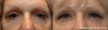 Woman's sagging under eye area before and after Morpheus8