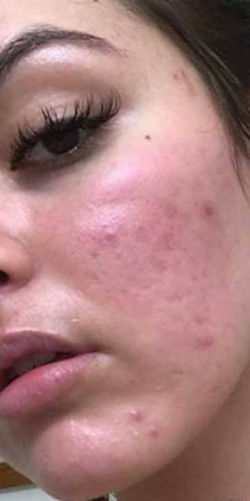 WunderHaut Anti-Aging Genius™ mit Radiofrequenz, LED Licht- und Mesotherapie, EMS und Elektroporation