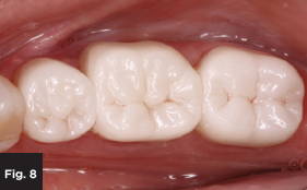 a finished, cleaned and cured monolithic zirconia crown in a patient mouth, occlusal view