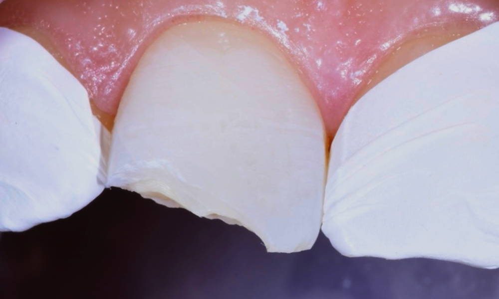 Fractured tooth in detail